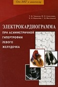 Татьяна Трешкур - Электрокардиограмма при асимметричной гипертрофии левого желудочка