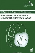  - Профилактика кариеса в ямках и фиссурах зубов