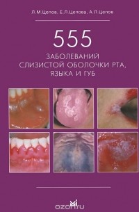  - 555 заболеваний слизистой оболочки рта, языка и губ