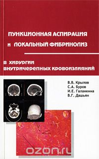  - Пункционная аспирация и локальный фибринолиз в хирургии внутричерепных кровоизлияний