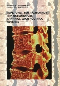  - Переломы тел позвонков при остеопорозе. Клиника, диагностика, лечение