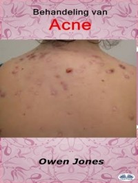 Owen Jones - Behandeling Van Acne