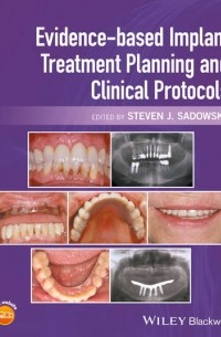 Evidence-based Implant Treatment Planning and Clinical Protocols