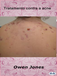 Owen Jones - Tratamento Contra A Acne