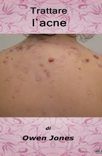 Owen Jones - Trattare L'Acne
